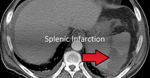 Splenic infarction header
