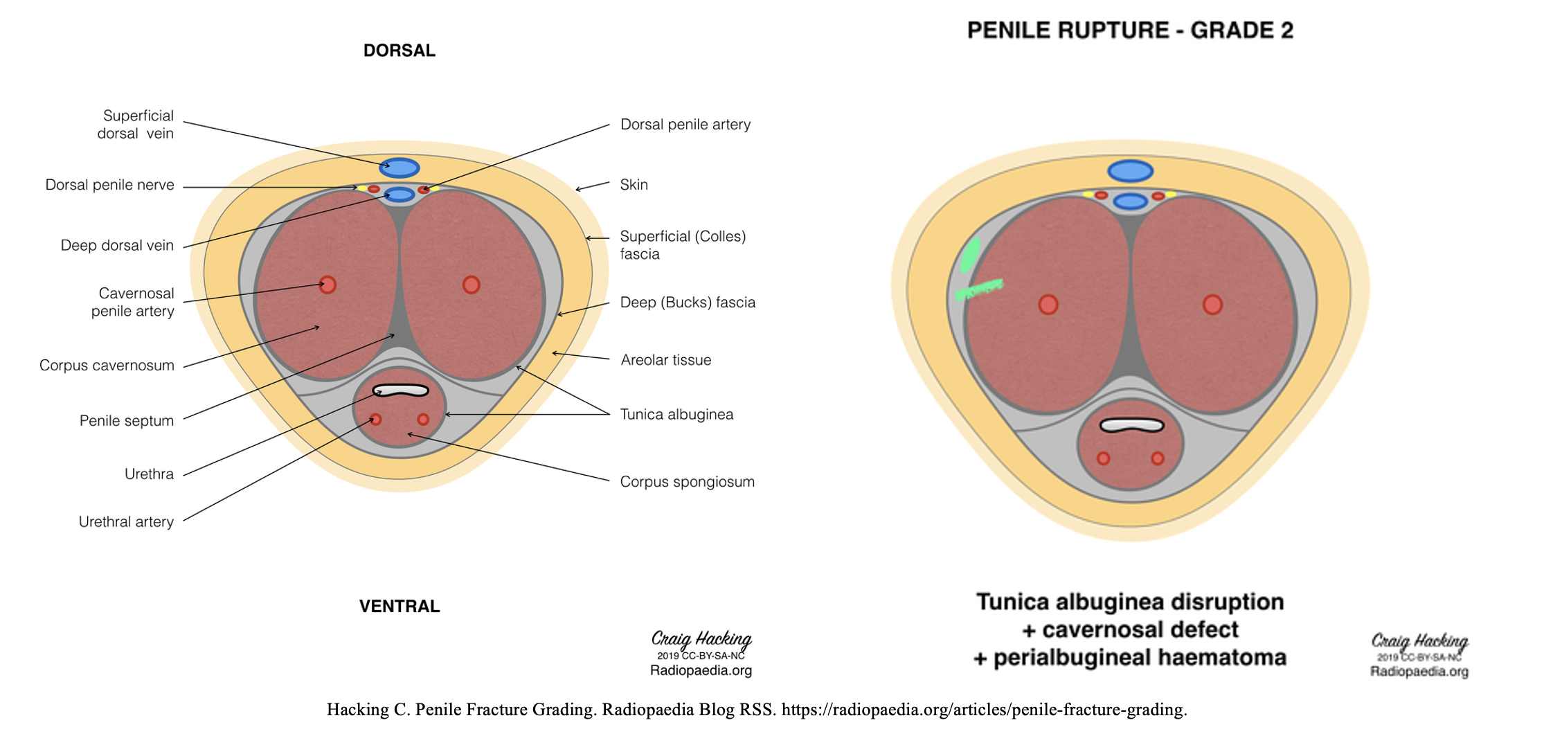 Penile Fracture Nhs Penile Fracture Nhs