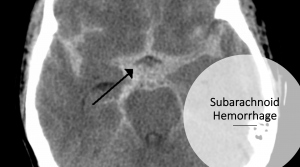Subarachnoid hemorrhage header