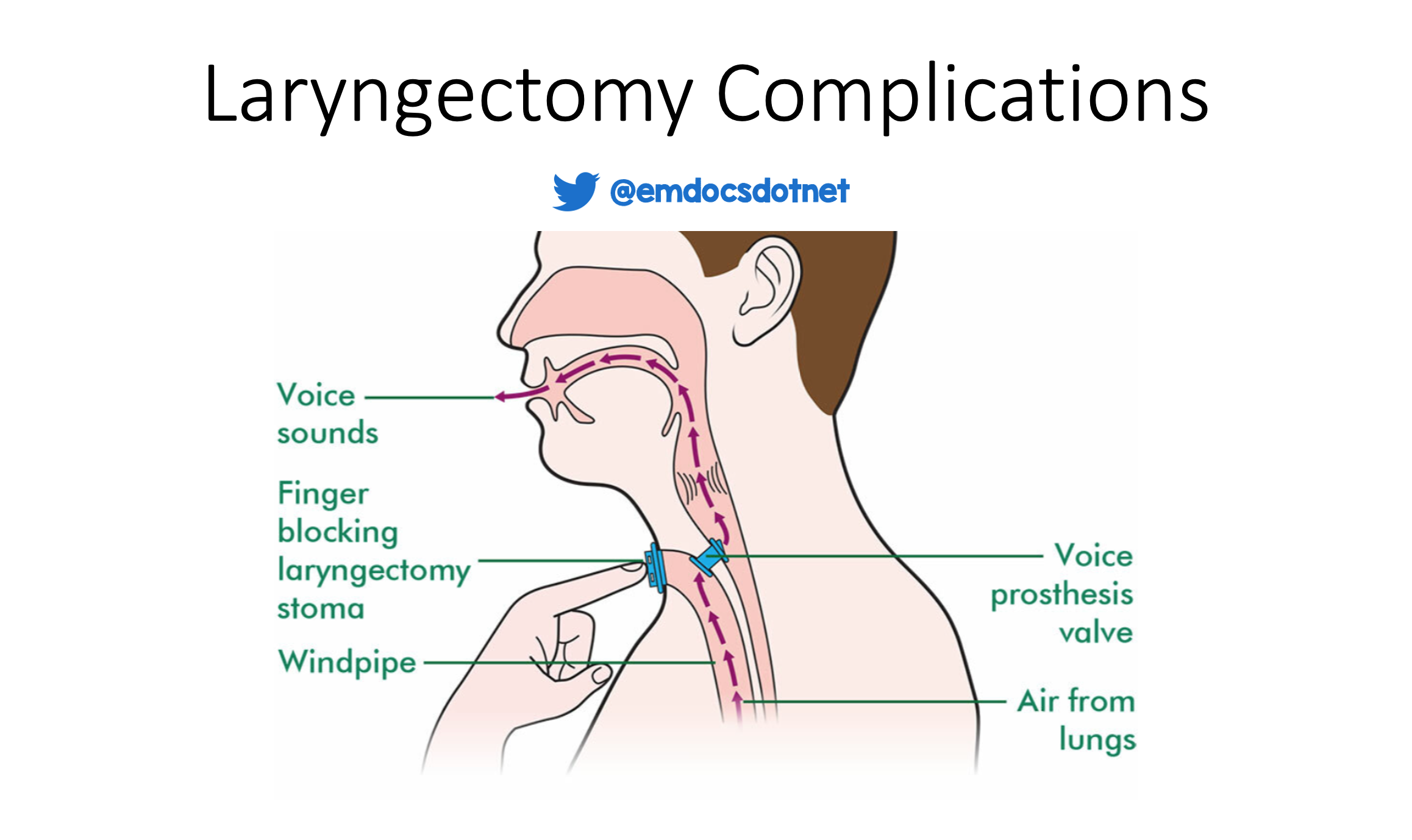 Laryngectomy Vs Tracheostomy