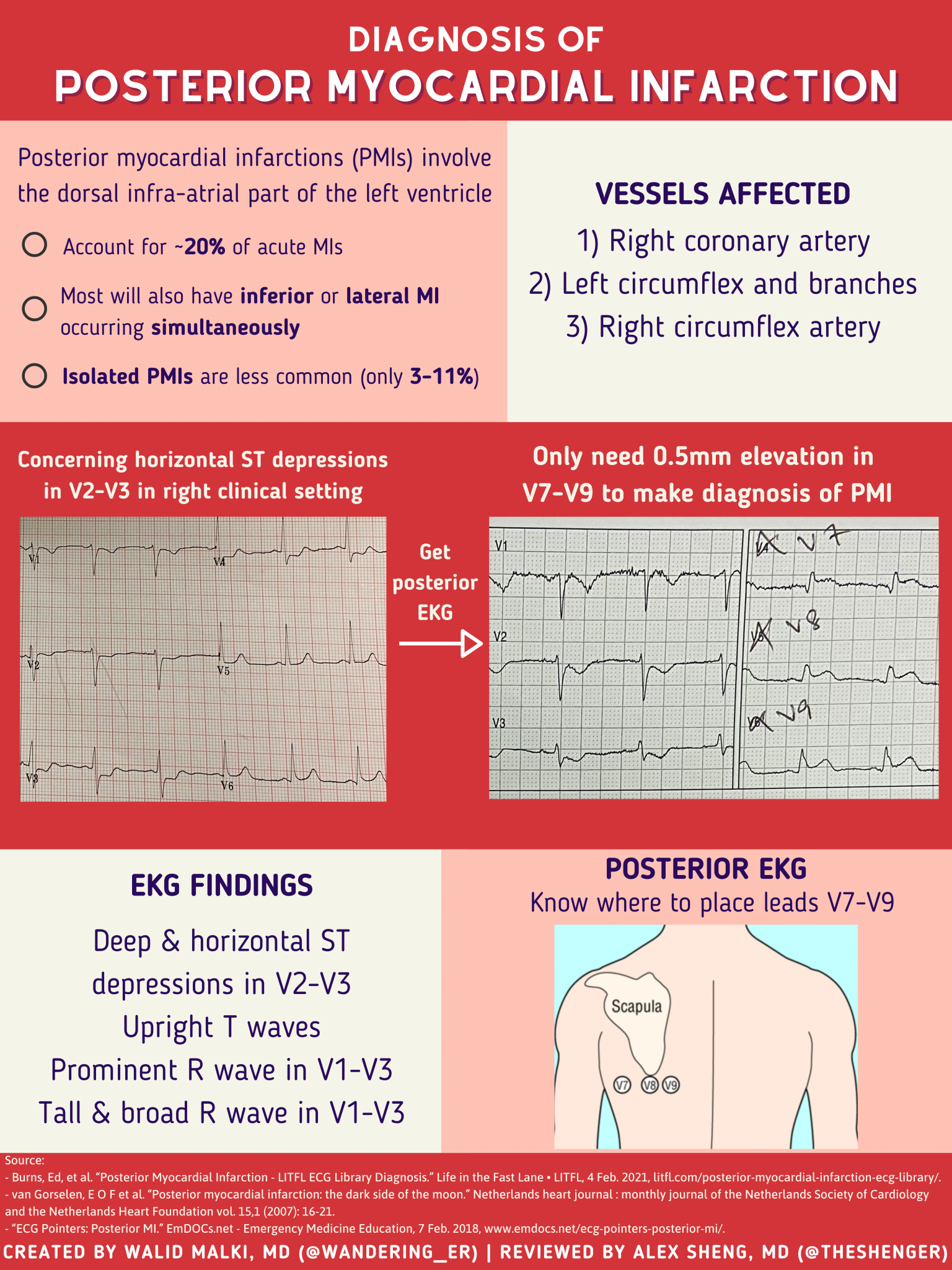 Posterior Mi Ecg:  The One Trick Every Clinician Needs - 49b4iga