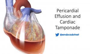 Pericardial effusion and tamponade header