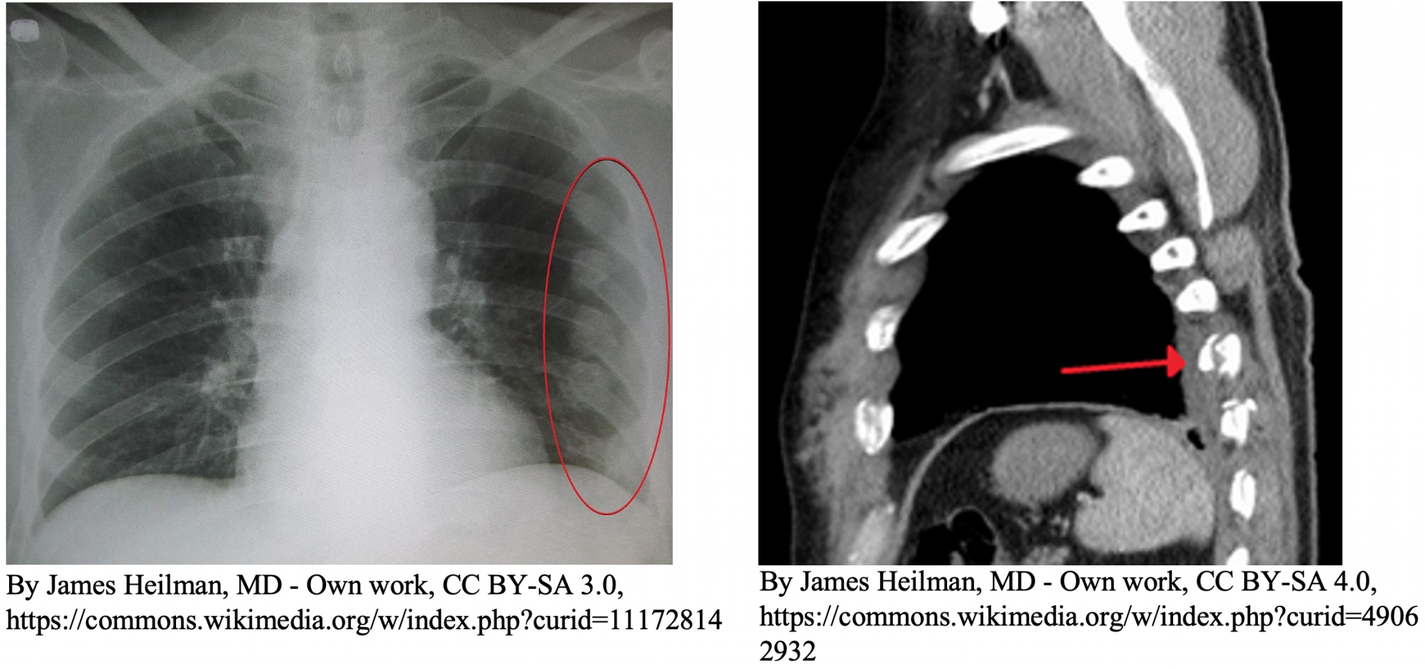Emergency Medicine EducationEM3AM Rib Fractures emDOCs