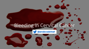 Bleeding in cervical cancer header