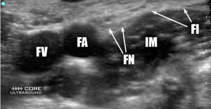 Ultrasound image of relevant anatomy for Infra-Inguinal Fascia Iliaca Nerve Block
