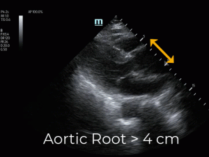 POCUS video of PSLAX showing dilated aortic root
