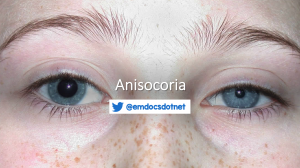 Anisocoria header