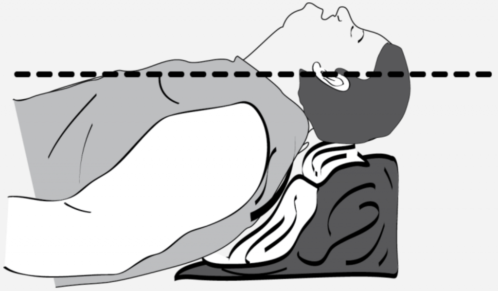 Intubation Ramping emDOCs Podcast - Episode 74: Upper Airway Obstruction Part 2 - emDocs