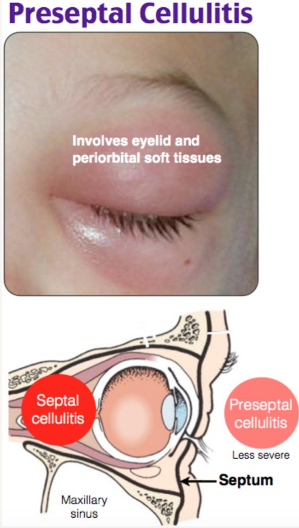 EM 3AM Periorbital Cellulitis EmDocs