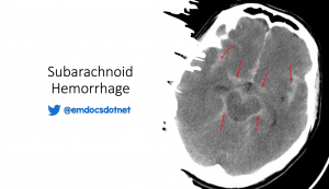 Subarachnoid hemorrhage header