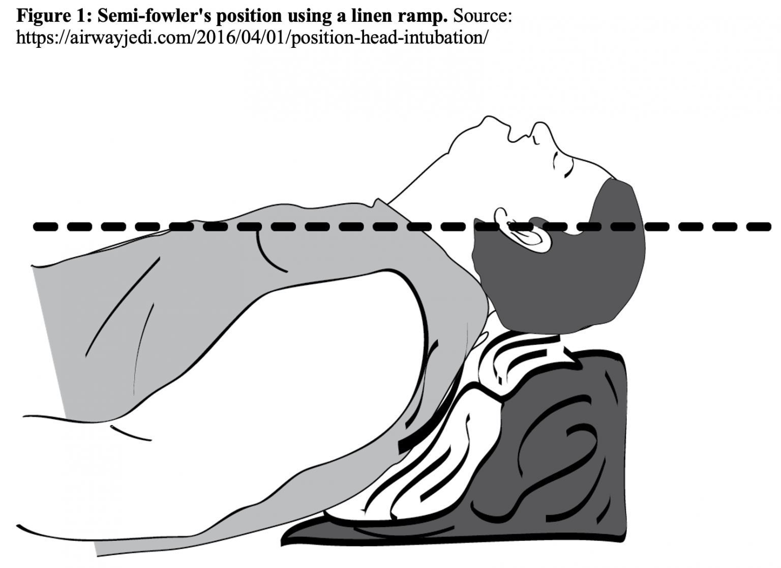 Anesthesia Ramp Position Beyond Ketamine: When to use Facilitated Intubation in the ED - emDocs