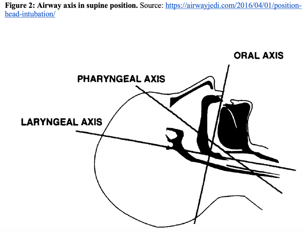 Intubation Ramping Beyond Ketamine: When to use Facilitated Intubation in the ED - emDocs