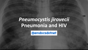 Pneumocystis jirovecii pneumonia and HIV header