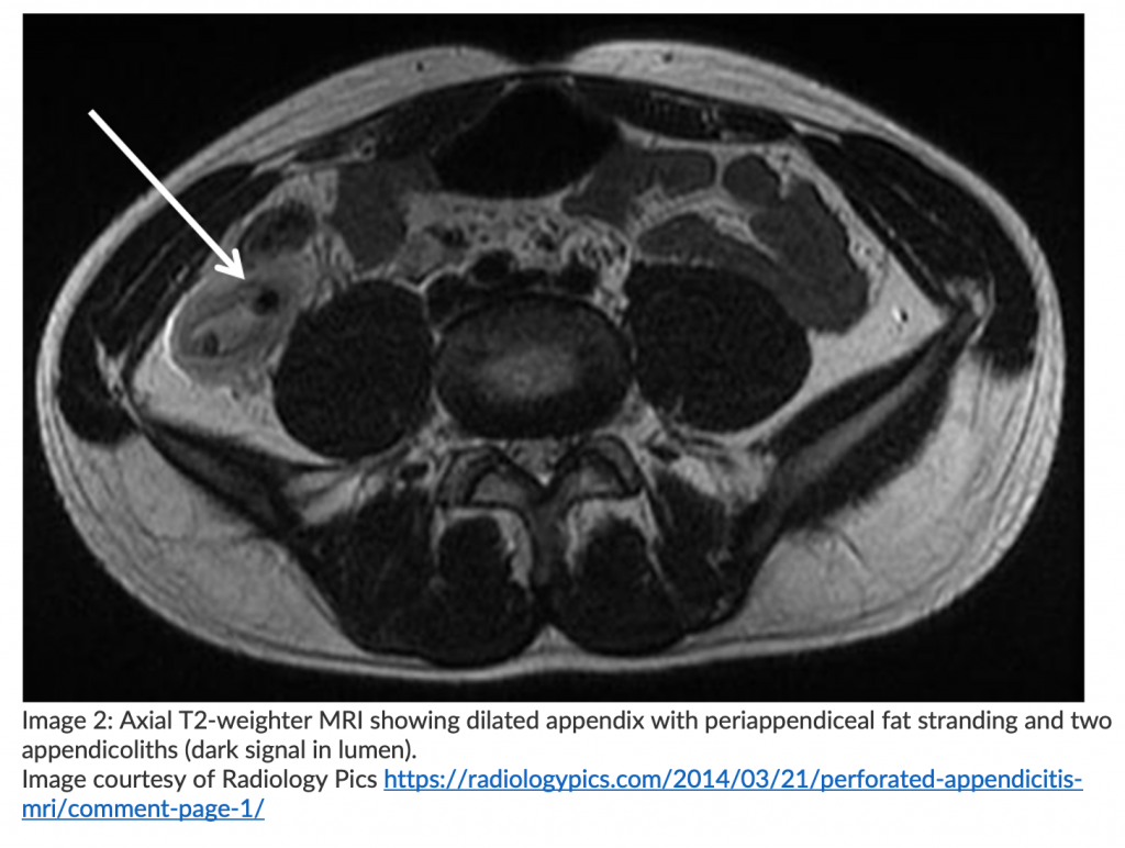 emDOCs Revamp: Appendicitis - emDocs