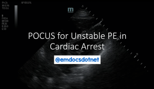 Header - POCUS for unstable PE in cardiac arrest