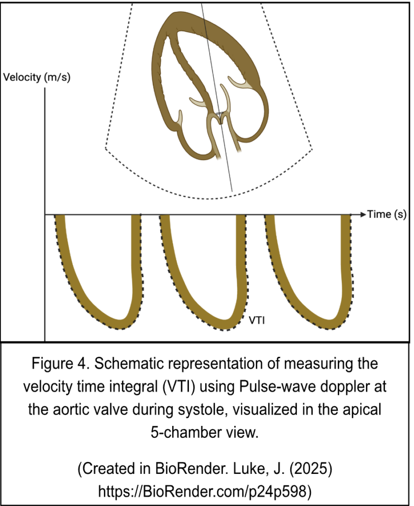 US Probe: Velocity Time Integral (VTI) in Sepsis Management - emDocs