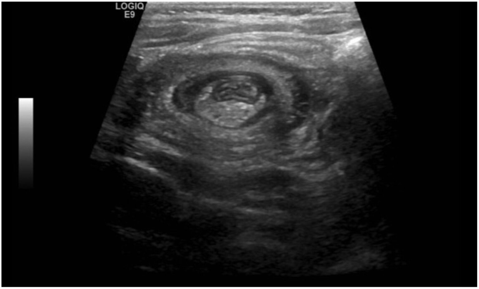 emDOCs Podcast – Episode 142: Pediatric Intussusception - emDocs