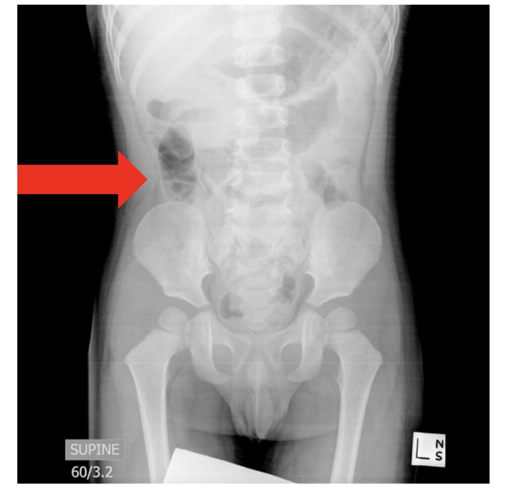 emDOCs Podcast – Episode 142: Pediatric Intussusception - emDocs