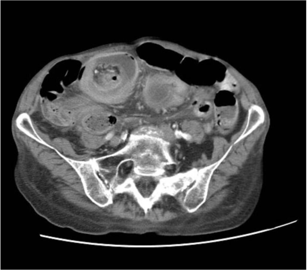 emDOCs Podcast – Episode 142: Pediatric Intussusception - emDocs