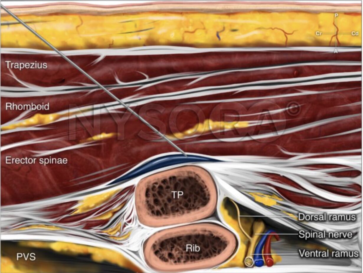 Espb Block Ultrasound Guided Erector Spinae Plane Block - emDocs