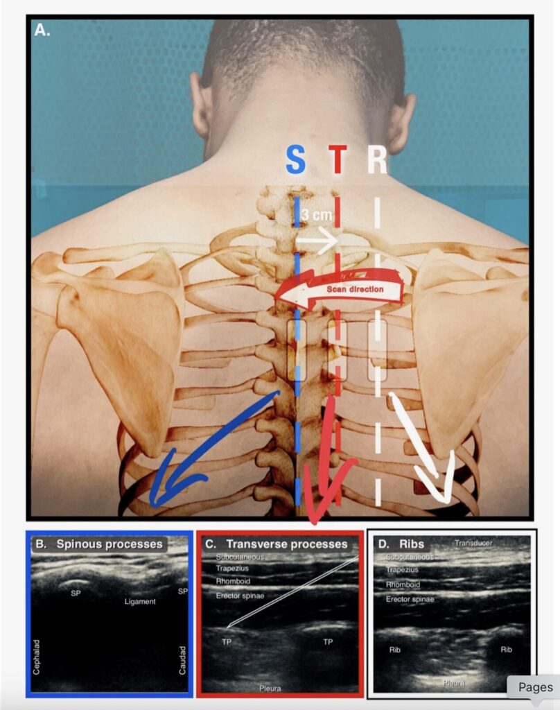 Espb Block Ultrasound Guided Erector Spinae Plane Block - emDocs