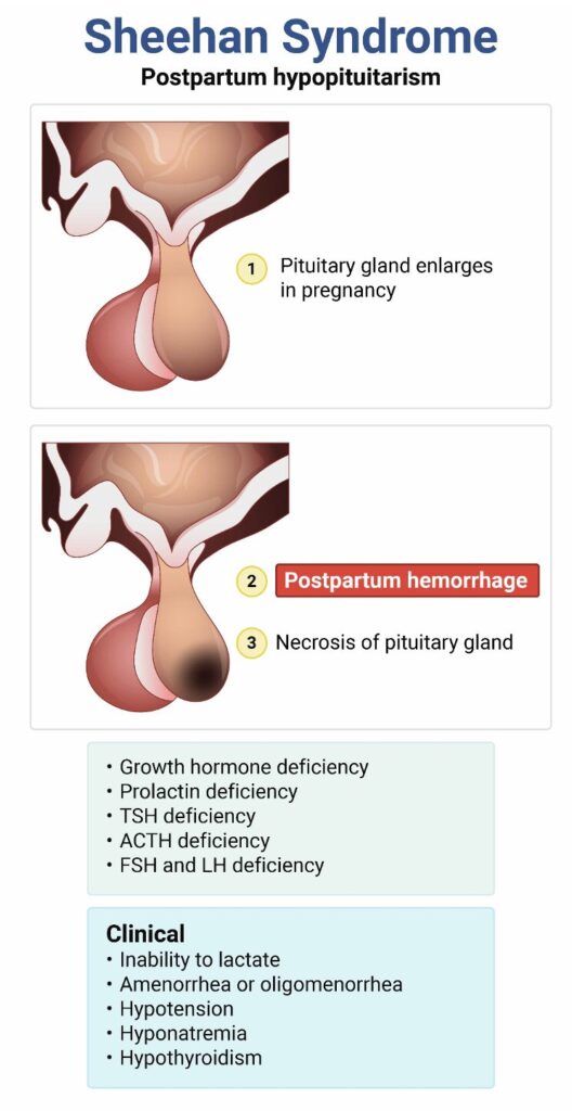 Sheehan Syndrome 
