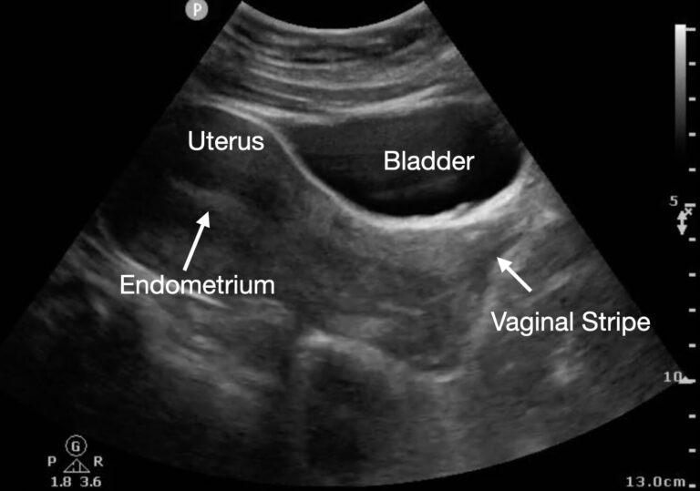 Point-of-Care Ultrasound for Recognizing Retained Products of ...