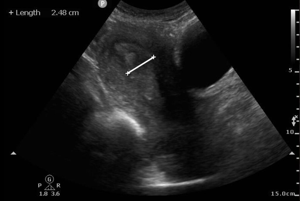 Measured endometrium that appears thickened and heterogeneous