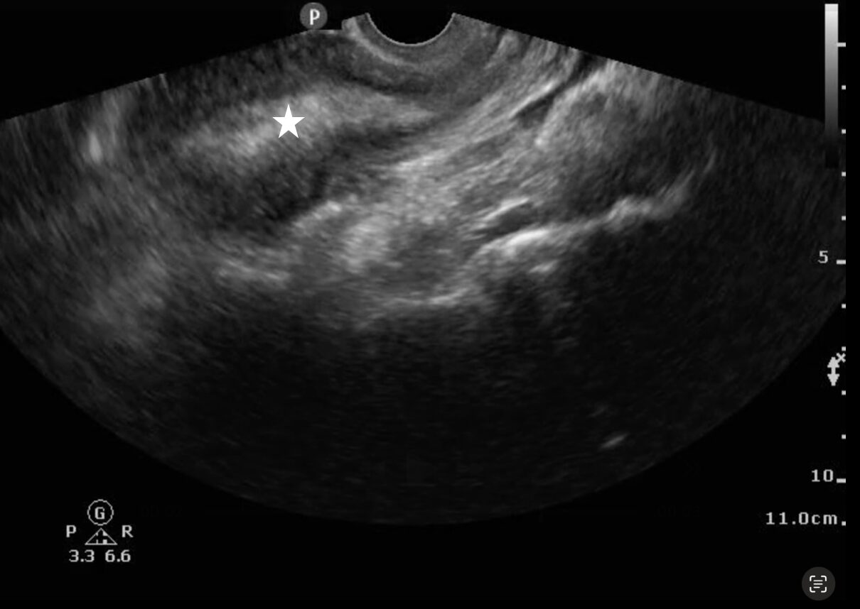 Transvaginal ultrasound showing a thickened endometrial stripe (white star) suggestive of retained products of conception
