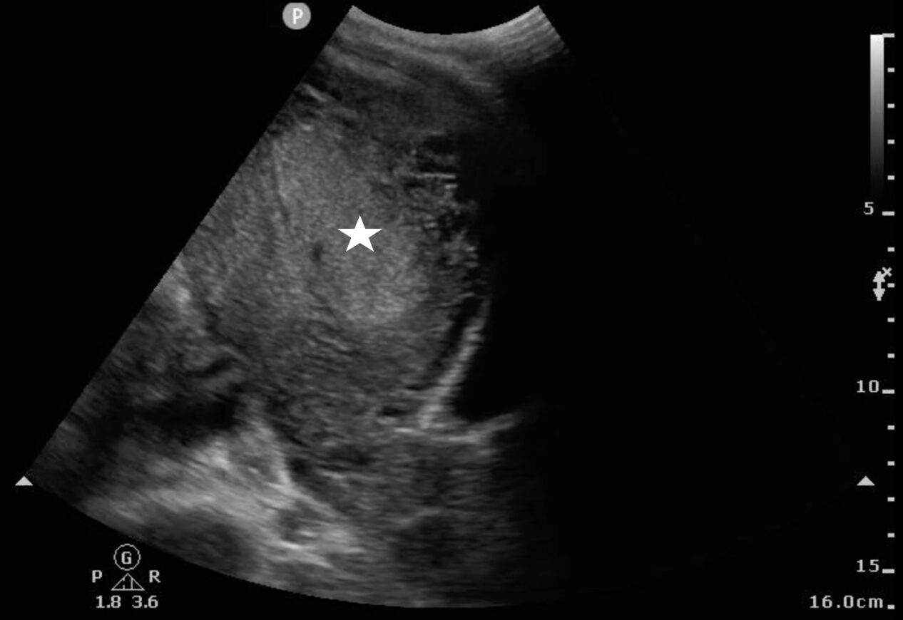 Transabdominal ultrasound showing a thickened endometrial stripe (white star) suggestive of retained products of conception
