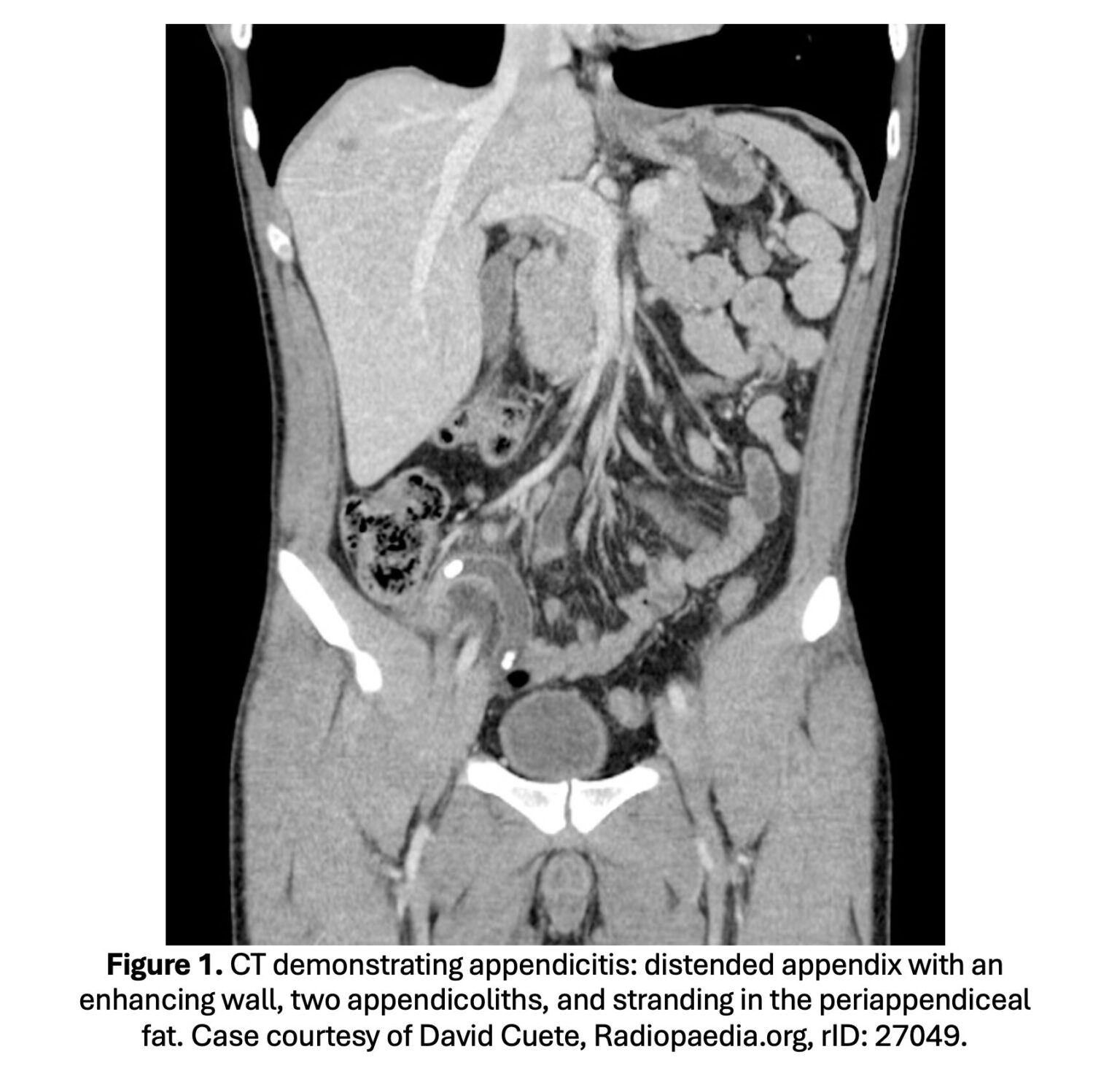emDOCs Podcast – Episode 139: EBM Acute Appendicitis in Adults Part 2 ...