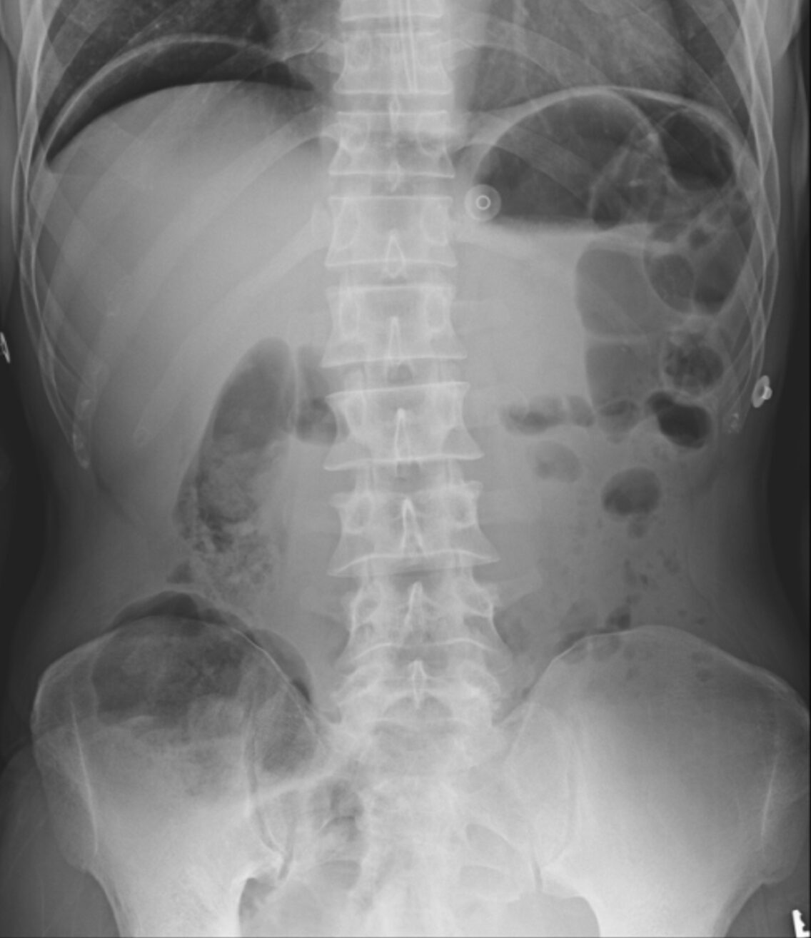 Figure 1 perforation