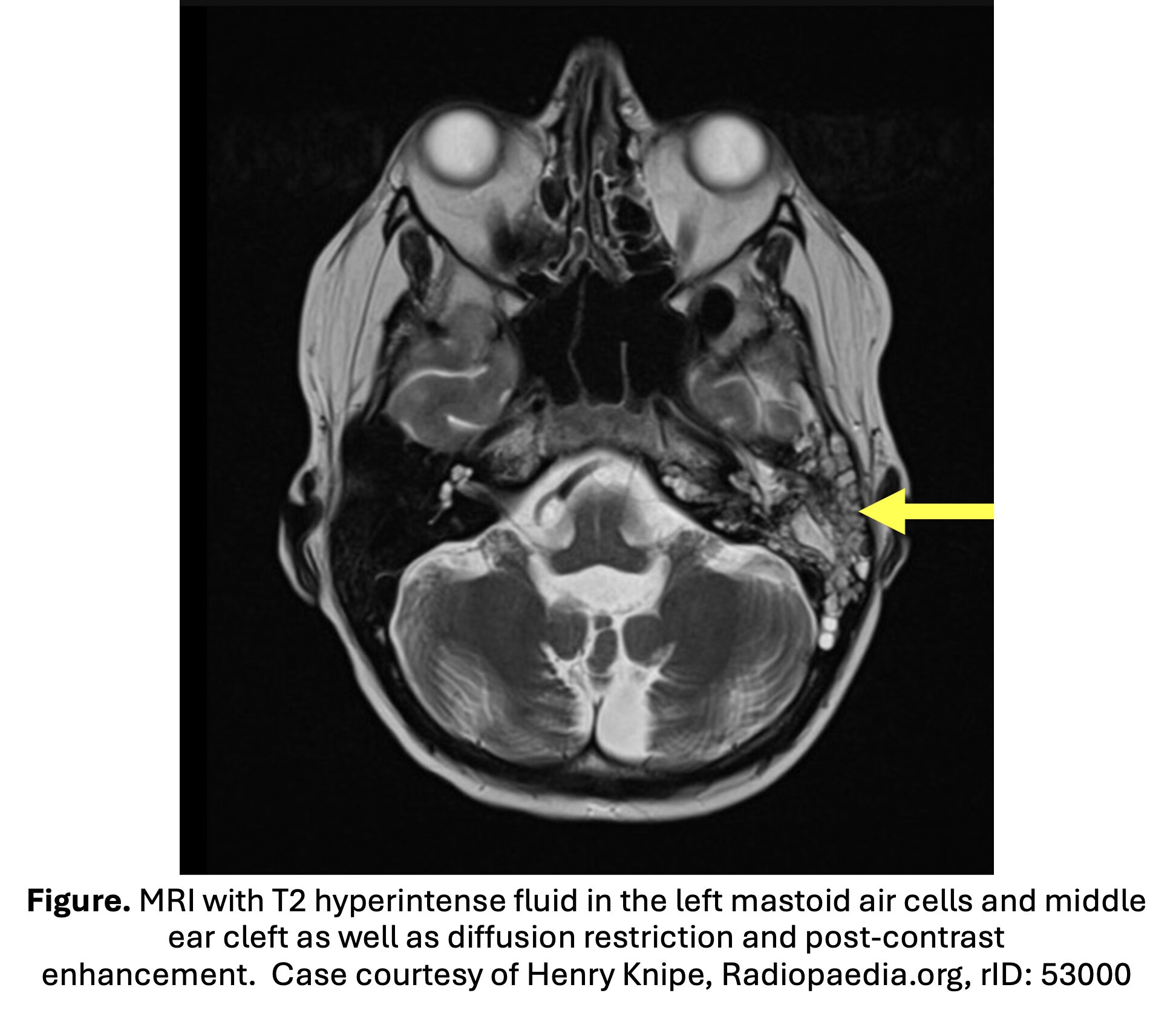 MRI mastoiditis