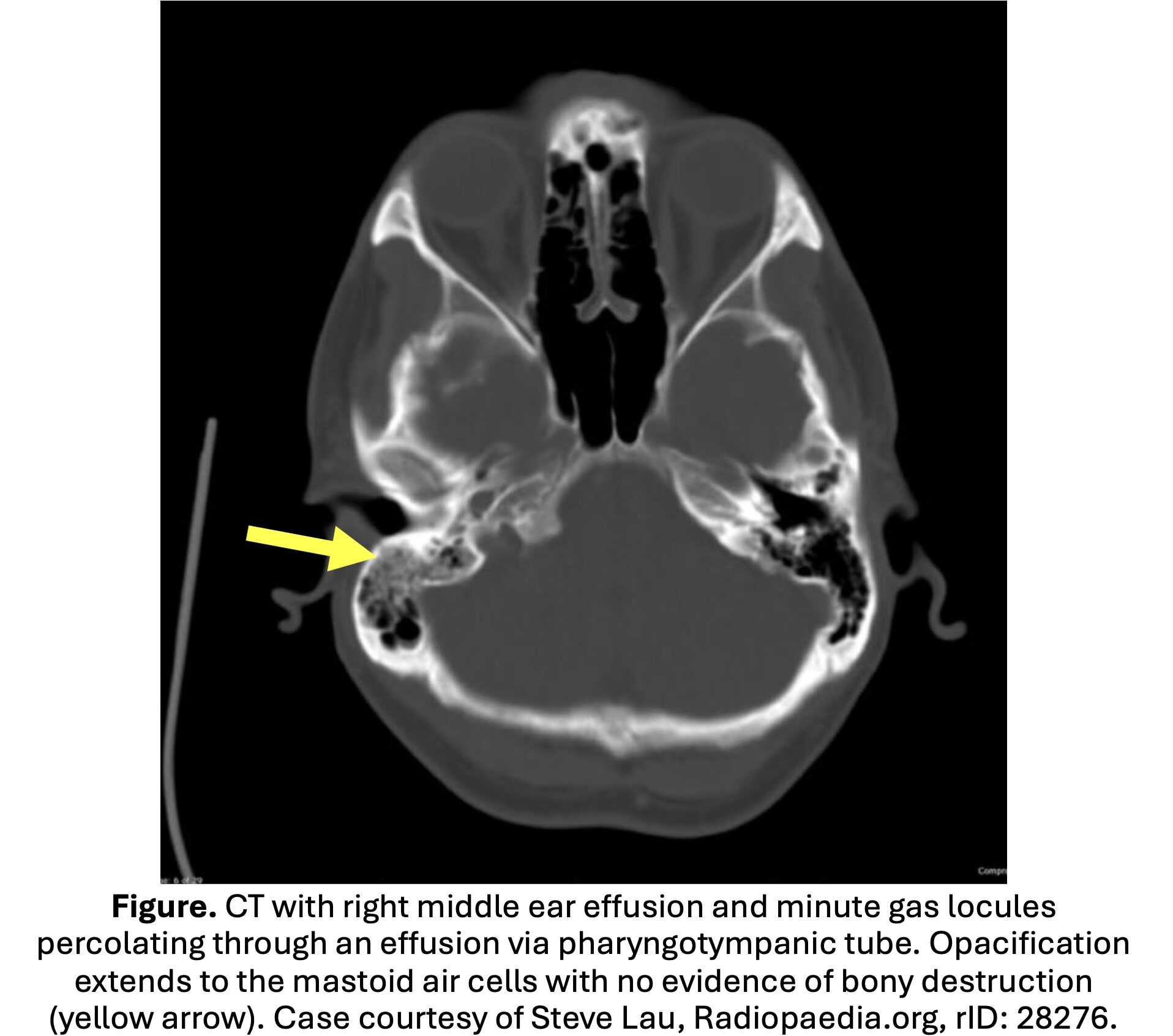 ct 1 mastoiditis