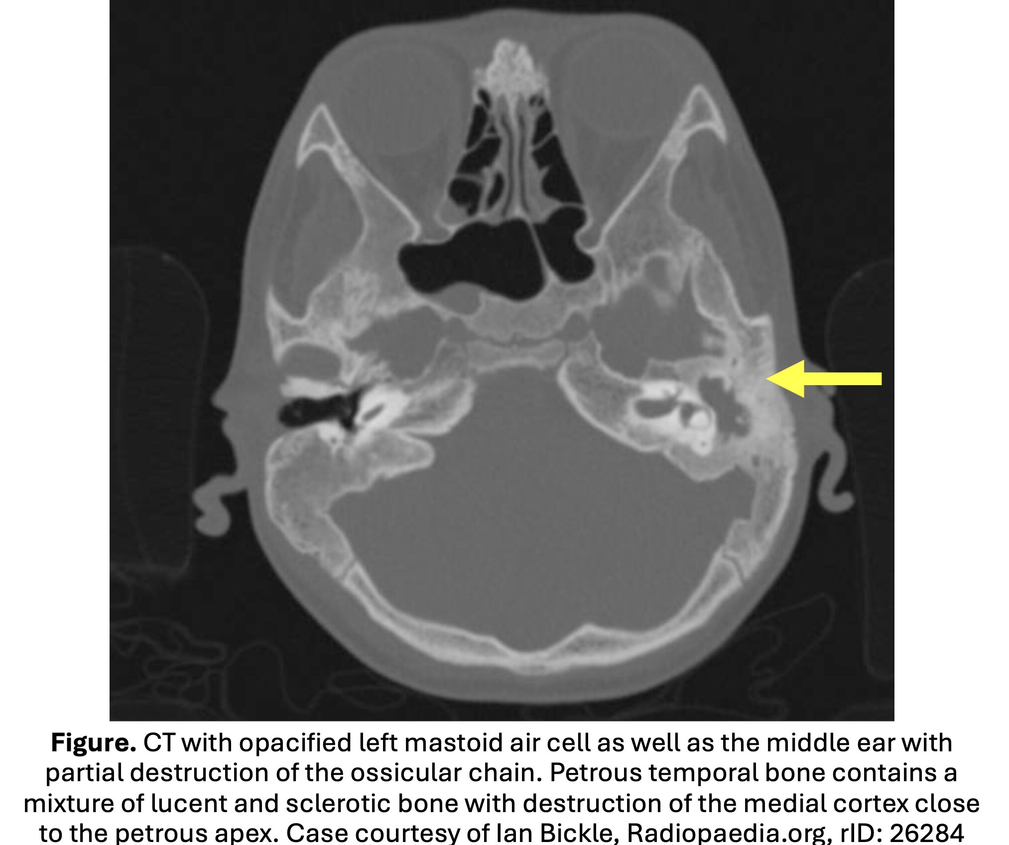 ct 2 mastoiditis