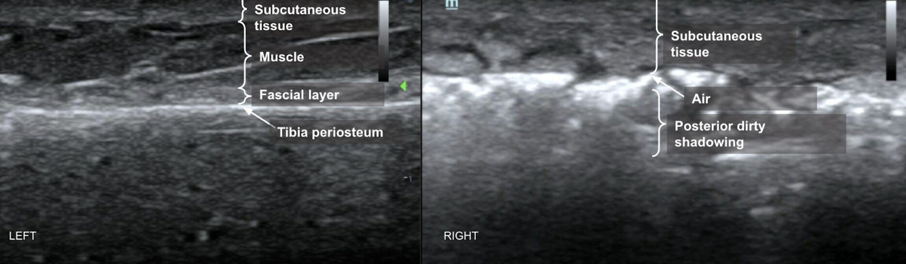 POCUS of NSTI showing air and posterior dirty shadowing