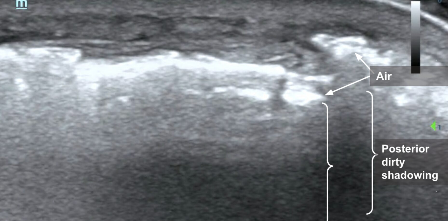 POCUS showing air and posterior dirty shadowing in NSTI