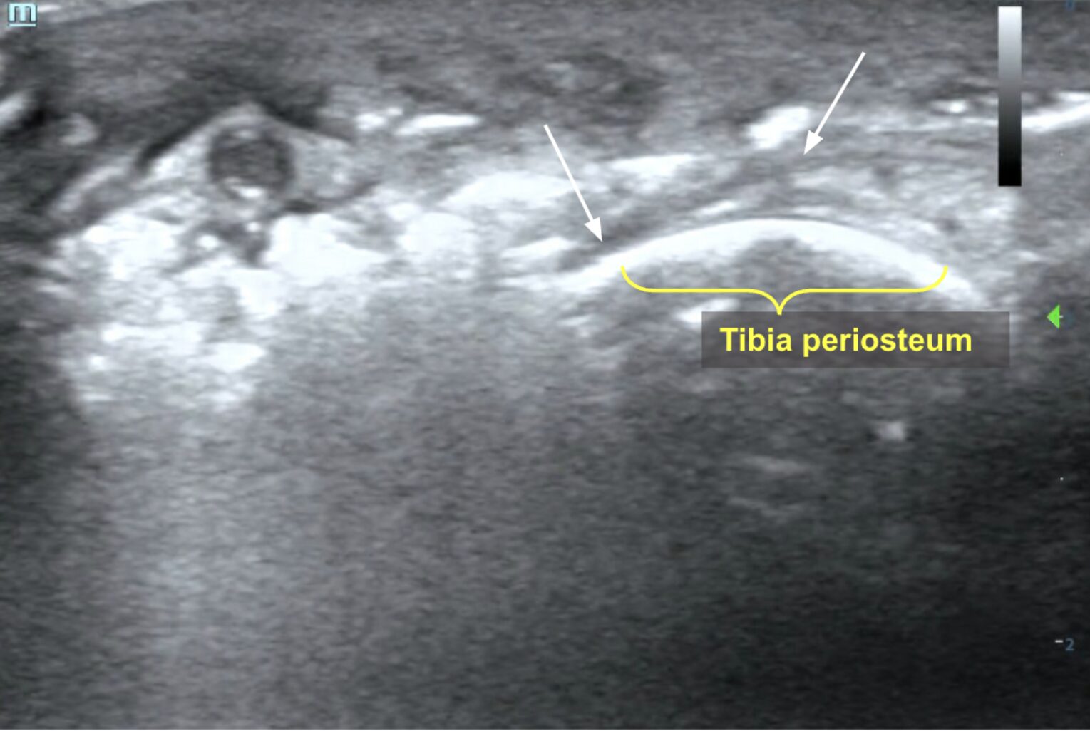 POCUS showing fascial fluid visualized deep to subcutaneous tissue invading deep into the muscle and overlying the tibia