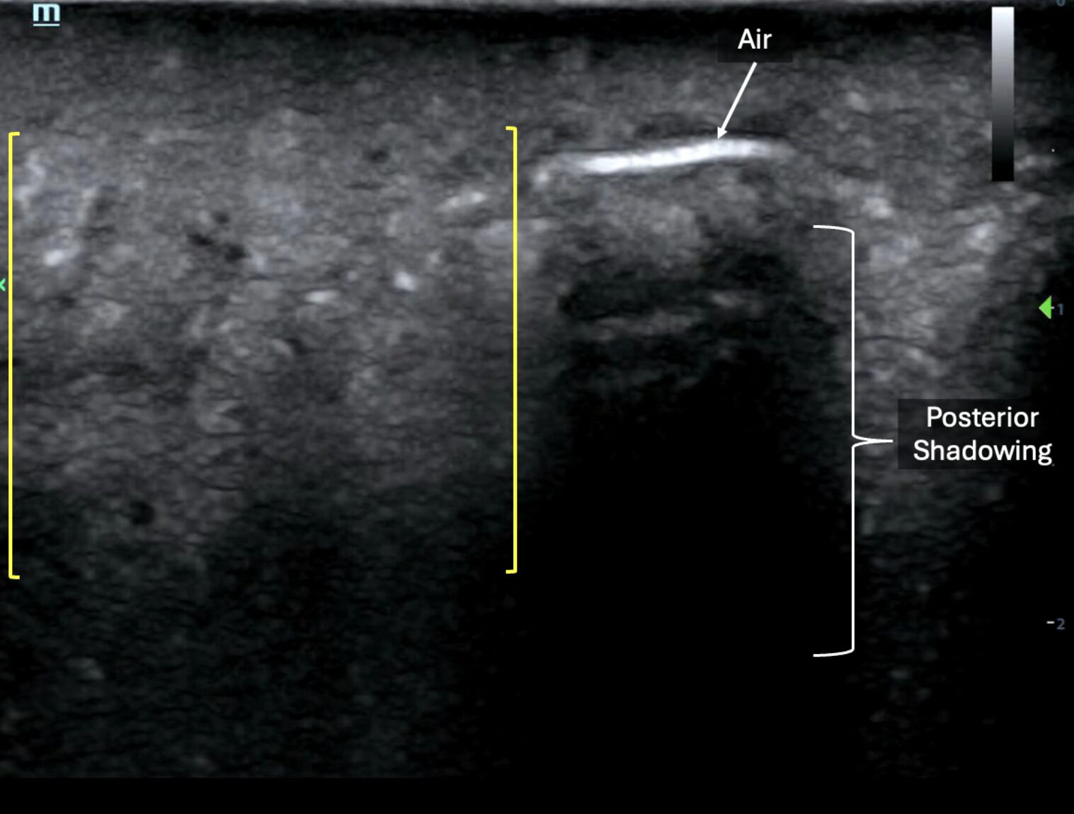 POCUS showing subcutaneous air and posterior shadowing (hyperechoic line to the right of the image) and purulence (left side of image)