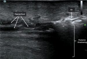 POCUS Diagnosis of NSTI - emDocs