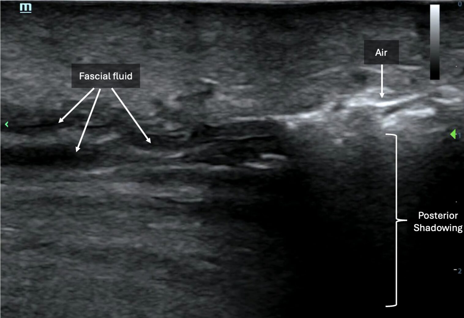 POCUS showing presence of subcutaneous emphysema (right side of image) and layering of fascial fluid (left side of image)