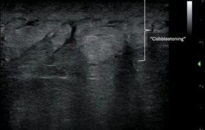 POCUS Diagnosis of NSTI - emDocs