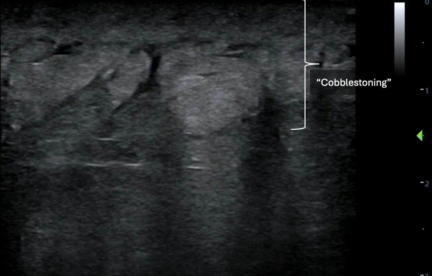 POCUS showing disorganized, globular changes localized to the subcutaneous tissue known as “cobblestoning"