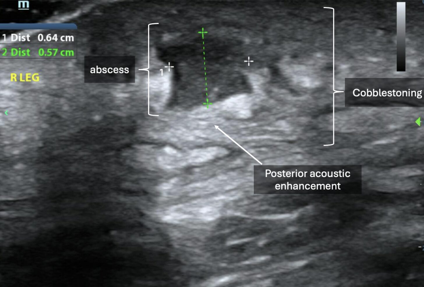 POCUS showing small, hypoechoic collection of material with posterior acoustic enhancement and adjacent cobblestoning