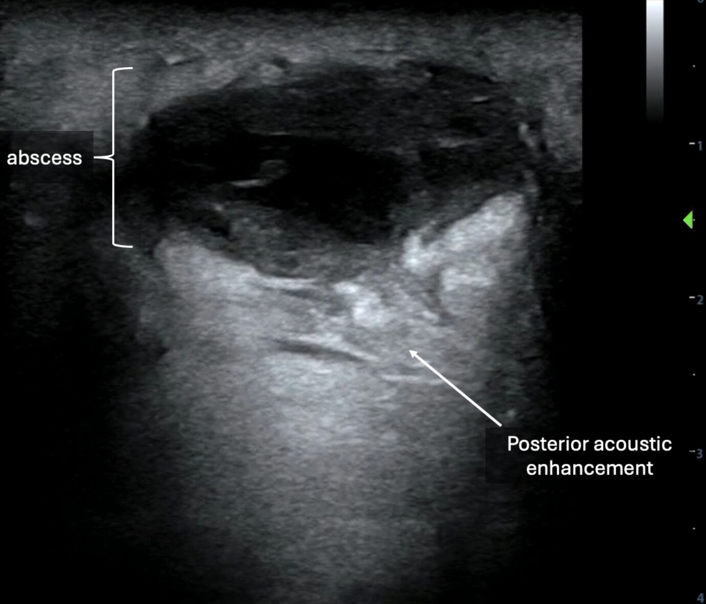 POCUS showing later clinical stage of abscess with more well-circumscribed collections with posterior acoustic enhancement