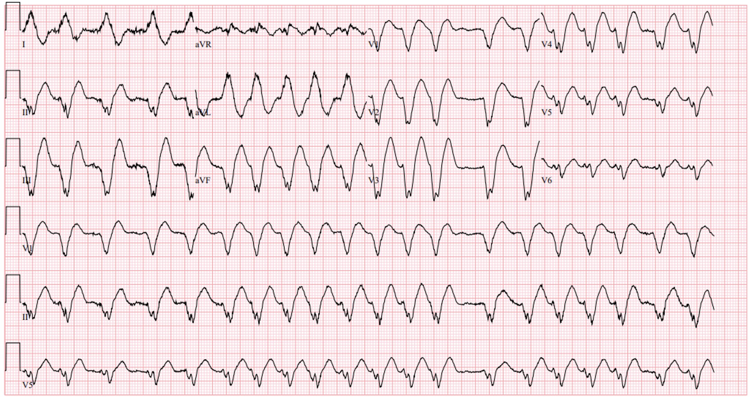 Flec ECG
