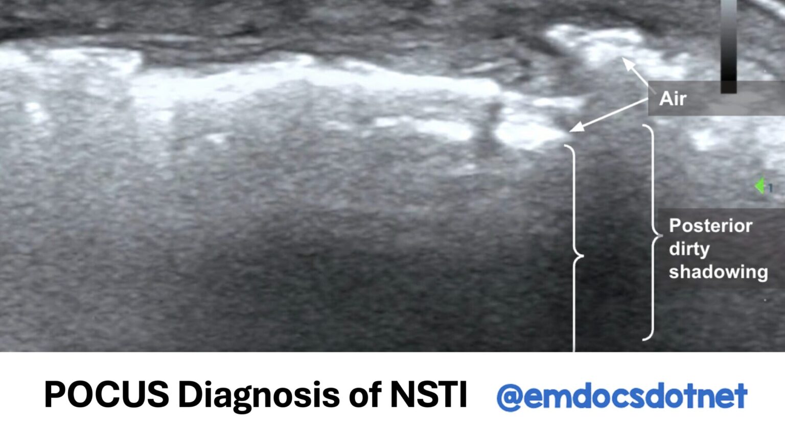Nsti Algorithm POCUS Diagnosis of NSTI - emDocs