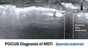 Feature POCUS NSTI