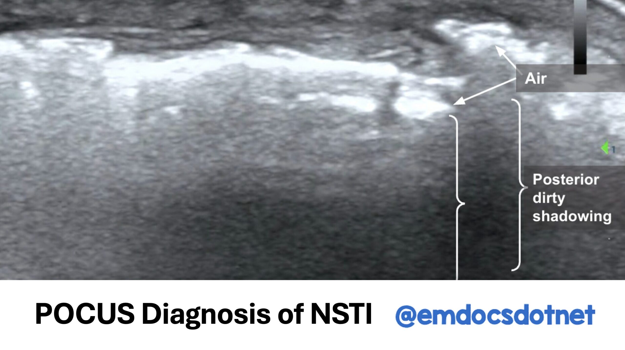 Feature POCUS NSTI