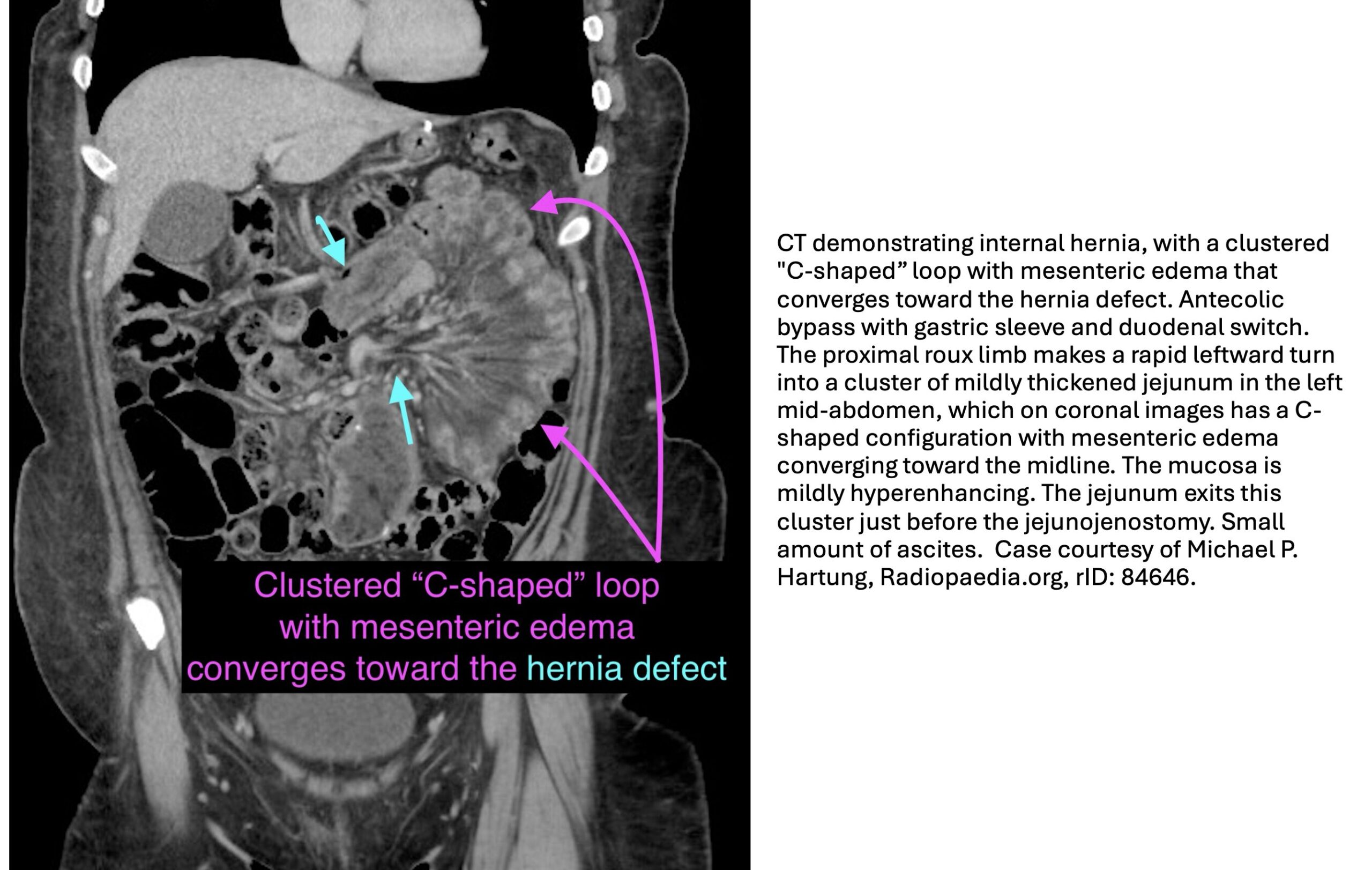 internal hernia 1